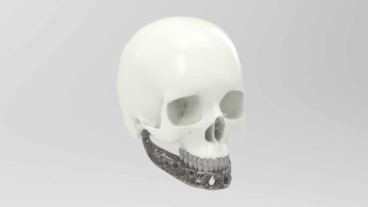 Inspire-implant1